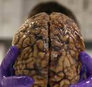 Vrouw die parkinson kan ruiken helpt wetenschap stap vooruit