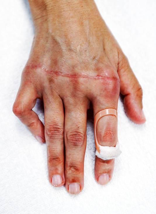 reuma aan vingers