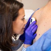 ‘Twintig jaar waarschuwen voor de zon komt nu als een boemerang terug’: waarom dermatologen vragen om minder controles