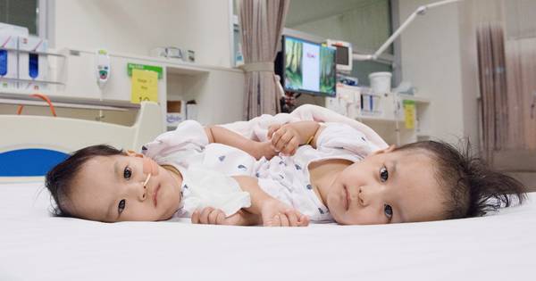 Australische dokters scheiden Siamese tweeling Nima en Dawa - BD.nl
