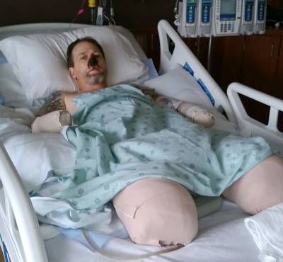 Man verliest handen en benen door hondenspeeksel, wetenschappers vinden genetische oorzaak