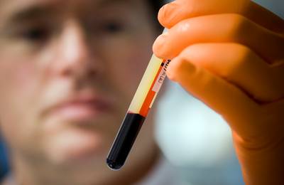 Buisje bloed voorspelt straks of je longkanker hebt