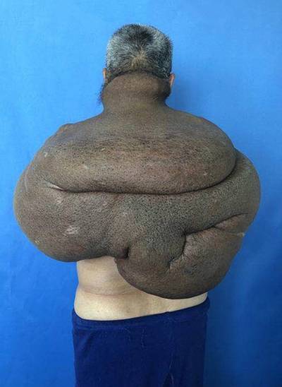 Chinese chirurgen verwijderen megatumor van bijna 15 kilo