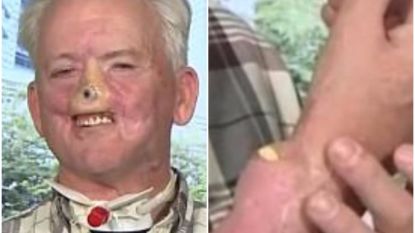 Man laat neus op arm groeien nadat hij werd aangevallen door beer