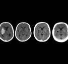 Te laag cholesterolgehalte verdubbelt risico op hersenbloeding