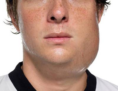 Na jaren van daling is de bof terug van weggeweest