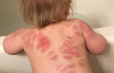 Moeder slaat alarm: ‘Mijn dochtertje werd 25 keer gebeten op de crèche en ze deden niks’