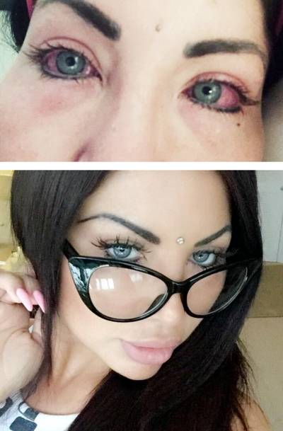 Instagram-model bijna blind na operatie met gekleurde oogimplantaten