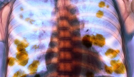 Mogelijk vaccin tegen longkanker in 2030: ‘Grote stap vooruit’