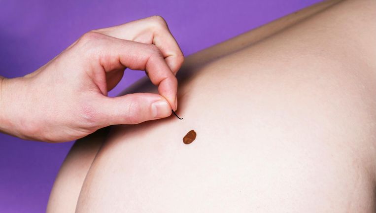 Moedervlek op handpalm