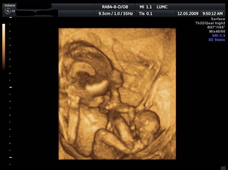 De Ene Foetus Overlijdt Om De Ander Te Redden Het Parool