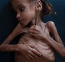 Uitgemergeld Jemenitisch meisje van wie foto de wereld rondging, is gestorven van de honger