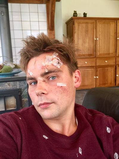 Stef (23) na mishandeling met glas: 'Bloed gutste eruit'