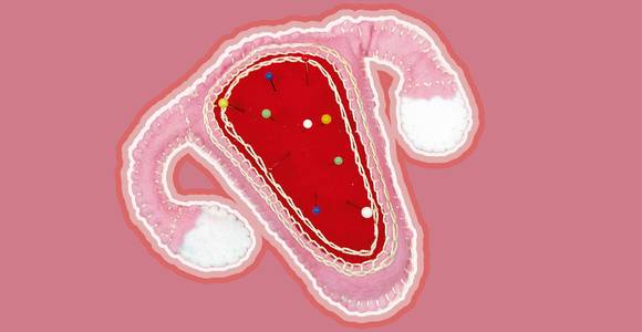Veel vrouwen worstelen met endometriose en krijgen nooit de juiste diagnose. “We moeten stoppen met pijnlijke menstruatie zo normaal te vinden” 