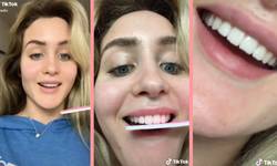 Je tanden vijlen is een hit op TikTok. Tandarts waarschuwt: “Volg deze trend niet!” 